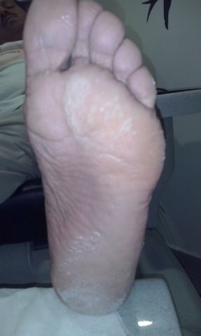 paciente con onicomicosis